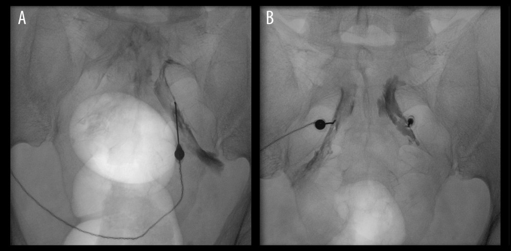 Fluoroscopic guidance during bilateral pulsed radiofrequency (PRF) treatment of the sacral (S2–S4) dorsal root ganglia (DRG) in Case 1. (A) Anteroposterior fluoroscopic view showing unilateral placement of a curved-tip radiofrequency needle within the S2 posterior sacral foramen; a Foley catheter balloon is visible within the bladder and was used as an anatomical landmark. (B) Anteroposterior fluoroscopic view after bilateral needle placement within the S2–S4 posterior sacral foramina, prior to sensory and motor stimulation testing and delivery of PRF current. PRF, pulsed radiofrequency; DRG, dorsal root ganglion; S2–S4, second to fourth sacral spinal levels.