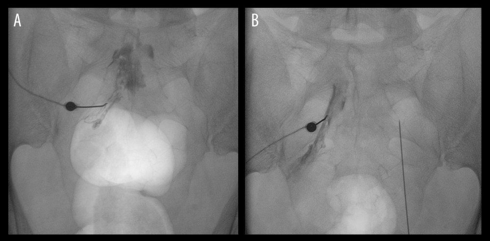 Fluoroscopic guidance during bilateral pulsed radiofrequency (PRF) treatment of the sacral (S2–S4) dorsal root ganglia (DRG) in Case 2. (A) Anteroposterior fluoroscopic view showing radiofrequency needle placement with contrast medium outlining the posterior sacral foramen and confirming epineural spread around the target nerve root; a Foley catheter balloon is visible within the bladder and was used as an anatomical landmark. (B) Anteroposterior fluoroscopic view after bilateral needle placement within the sacral posterior foramina, prior to sensory and motor stimulation testing and delivery of PRF current. PRF, pulsed radiofrequency; DRG, dorsal root ganglion; S2–S4, second to fourth sacral spinal levels.