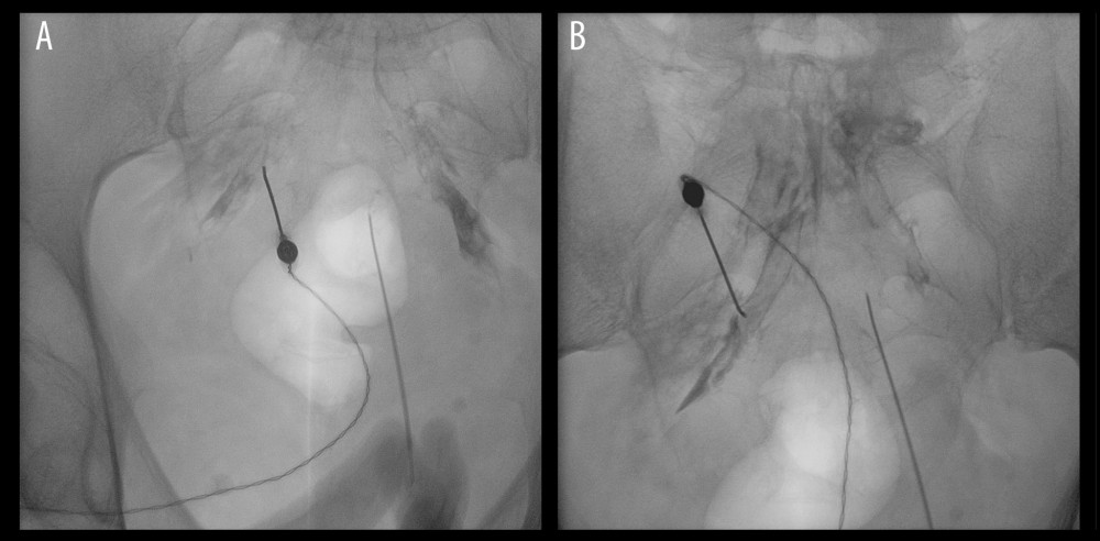 Fluoroscopic guidance during bilateral pulsed radiofrequency (PRF) treatment of the sacral (S2–S4) dorsal root ganglia (DRG) in Case 3. (A) Anteroposterior fluoroscopic view showing unilateral placement of a curved-tip radiofrequency needle within the posterior sacral foramen; a Foley catheter balloon is visible within the bladder and was used as an anatomical landmark. (B) Anteroposterior fluoroscopic view after bilateral needle placement within the sacral posterior foramina, prior to sensory and motor stimulation testing and delivery of PRF current. PRF, pulsed radiofrequency; DRG, dorsal root ganglion; S2–S4, second to fourth sacral spinal levels.