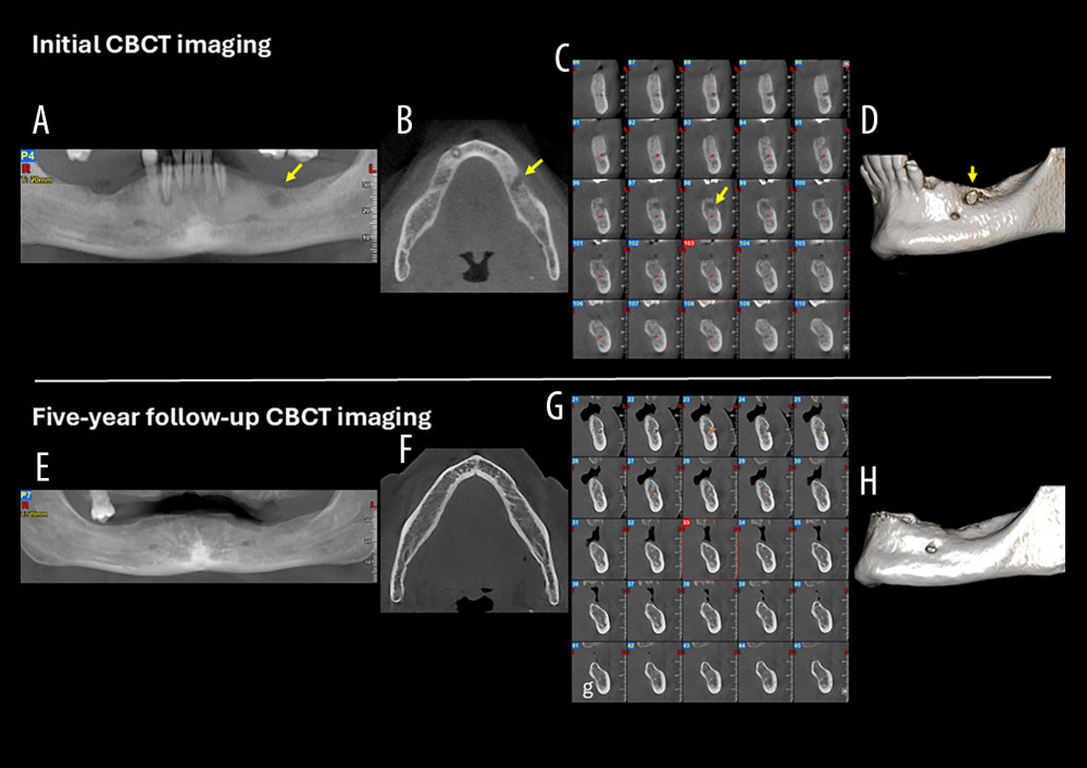 Case 1. (A) Cone-beam computed tomography (CBCT) panoramic reconstruction showing an ill-defined osteolytic lesion in the left edentulous mandibular body (yellow arrow). (B) CBCT axial slice demonstrating the infiltrative nature of the lesion and erosion of the buccal cortical plate (yellow arrow). (C) CBCT cross-sectional images illustrating the moth-eaten pattern of bone destruction (yellow arrow), with cortical erosion and infiltration and involvement of the mandibular canal (red dots). (D) CBCT three-dimensional (3D) reconstruction showing erosion and infiltration of the buccal cortical plate (yellow arrow). (E) Five-year follow-up CBCT panoramic reconstruction showing complete resolution of the osteolytic lesion and restoration of mandibular bone density. (F) Five-year follow-up CBCT axial slice demonstrating reconstitution of the buccal cortical plate. (G) Five-year follow-up CBCT cross-sectional images revealing bone remodeling and a clearly delineated, uninvolved mandibular canal. (H) Five-year follow-up CBCT 3D reconstruction illustrating healing of the previous cortical defect, with a smooth and continuous mandibular surface.