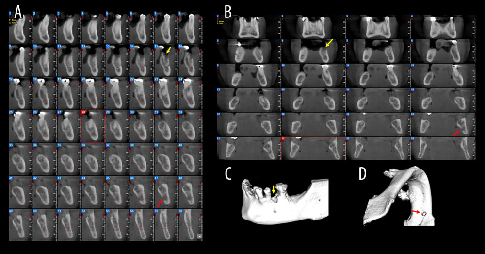 Case 2. (A) Cone-beam computed tomography (CBCT) cross-sectional images demonstrating 2 distinct, ill-defined osteolytic lesions in the left posterior mandible. Lesion 1 (yellow arrows) shows alveolar crest infiltration and lesion 2 (red arrows) shows lingual cortical plate infiltration. (B) CBCT coronal slices highlighting the infiltrative nature of the lesions (yellow and red arrows). (C) CBCT three-dimensional (3D) reconstruction of lesion 1 showing alveolar crest infiltration (yellow arrow). (D) 3D reconstruction of lesion 2 showing lingual infiltration (red arrow).