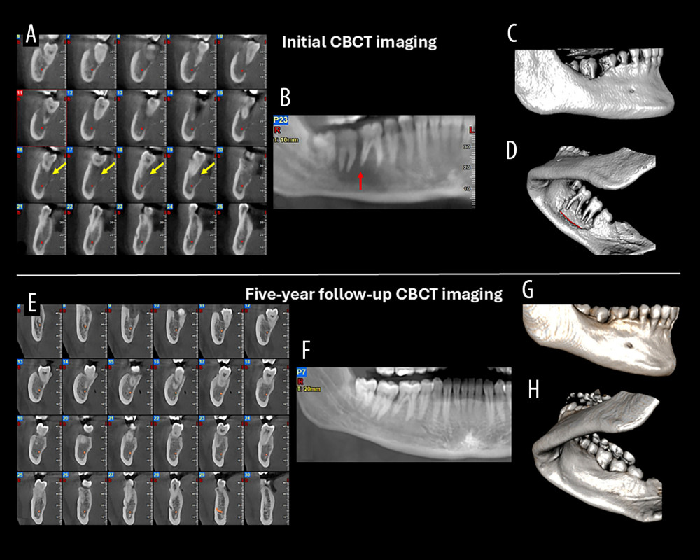 Case 3. (A) Cone-beam computed tomography (CBCT) cross-sectional images showing moth-eaten bone destruction (yellow arrows) and involvement of the mandibular canal (red dots). (B) CBCT panoramic reconstruction demonstrating the floating teeth appearance and spiked-tooth effect (red arrow). (C, D) CBCT three-dimensional (3D) reconstructions (buccal and lingual views) demonstrating lingual cortical perforation and destruction of the supporting alveolar bone of the molars. (E) Five-year follow-up CBCT cross-sectional images showing complete healing of the osteolytic lesion and restoration of the lingual cortical plate. (F) Five-year follow-up CBCT panoramic reconstruction showing complete osseous support of the affected teeth. (G, H) Five-year follow-up CBCT 3D reconstructions showing complete healing of the osteolytic lesion and restoration of the lingual plate.