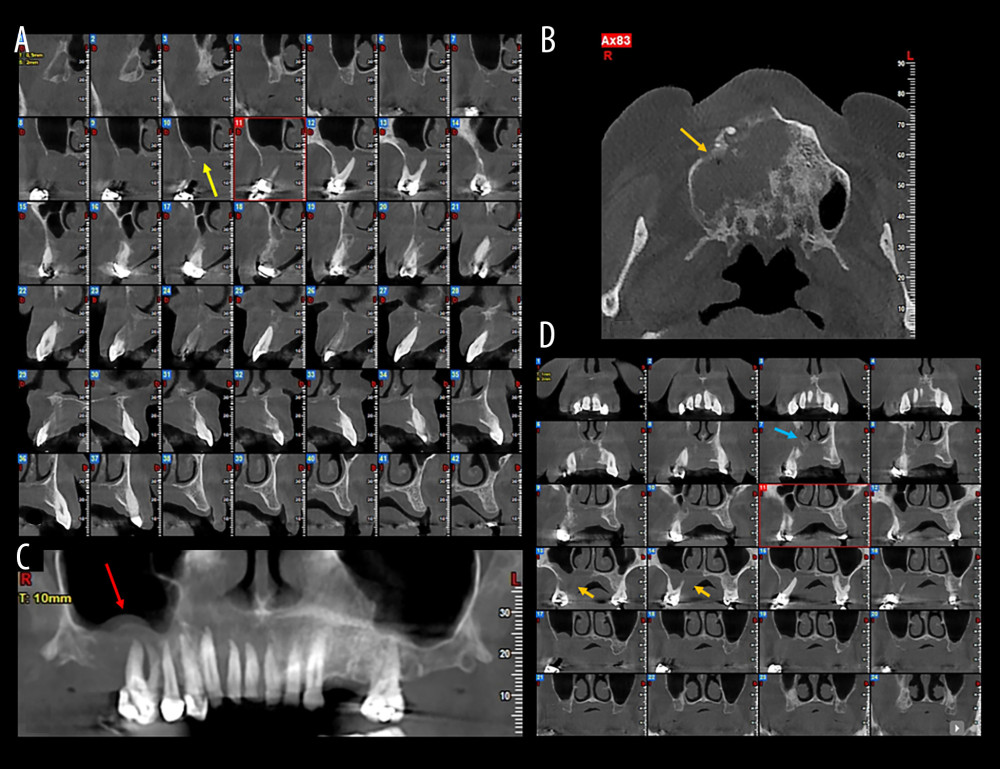 Case 4. (A) Cone-beam computed tomography (CBCT) cross-sectional images illustrating extensive alveolar bone destruction and cortical plate erosion (yellow arrow). (B) CBCT panoramic reconstruction showing the floating teeth appearance and spiked-tooth effect in the right posterior maxilla (red arrow). (C) CBCT axial slice demonstrating the infiltrative lesion with osseous destruction extending into the maxillary sinus and nasal cavity (orange arrow). (D) CBCT coronal slices highlighting maxillary sinus (orange arrows) and nasal cavity involvement (blue arrow).