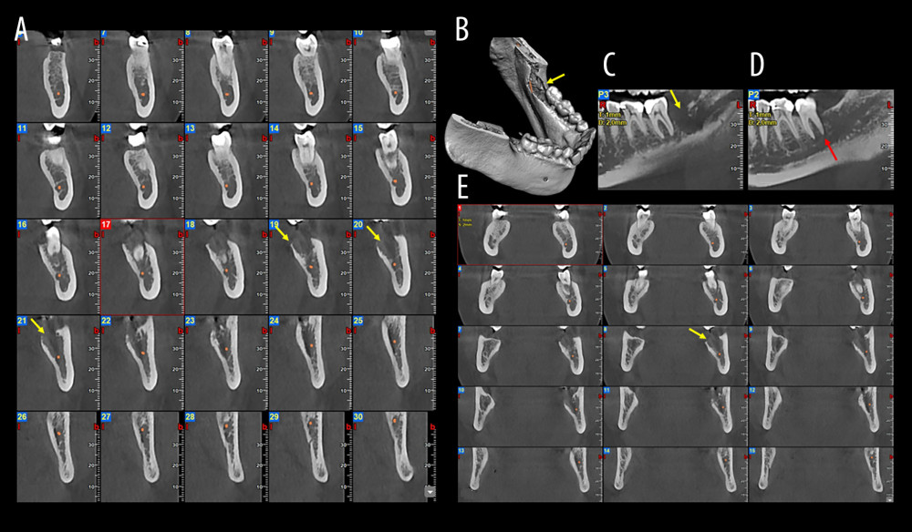 Case 5. (A) Cone-beam computed tomography (CBCT) cross-sectional images illustrating the ill-defined osteolytic lesion, trabecular disruption, and cortical thinning (yellow arrows). (B) CBCT three-dimensional reconstruction demonstrating localized cortical erosion (yellow arrow). (C, D) CBCT panoramic reconstructions highlighting infiltrative bone loss (yellow arrow) and the characteristic spiked-tooth effect at the distal root of the second molar (red arrow). (E) CBCT coronal slices showing the osteolytic lesion (yellow arrow).