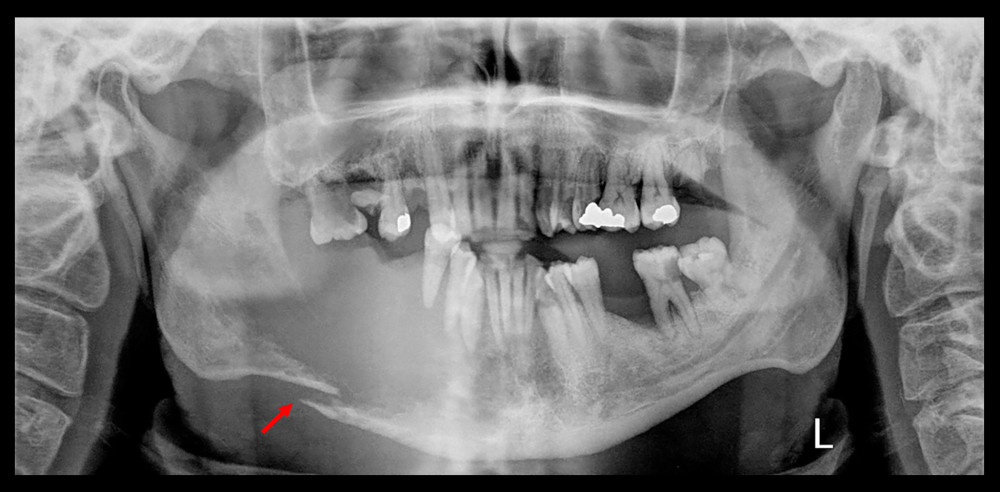 Initial panoramic radiograph of Case 6 demonstrating an extensive osteolytic destruction of the right mandibular body, characterized by loss of normal trabecular architecture, ill-defined margins, and pathological fracture of the lower border of the mandible (red arrow).
