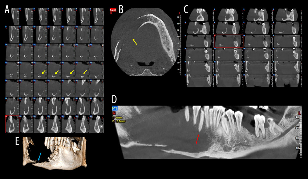 Case 6. (A) Cone-beam computed tomography (CBCT) cross-sectional slices demonstrating complete destruction of the right mandibular body (yellow arrows). (B) CBCT axial slice showing extensive lesion in the right mandibular body (yellow arrow). (C) CBCT coronal slices and (D) panoramic reconstruction highlighting the characteristic floating teeth appearance and spiked-tooth effect (red arrow). (E) CBCT three-dimensional reconstruction revealing a pathological fracture of the inferior border (blue arrow).