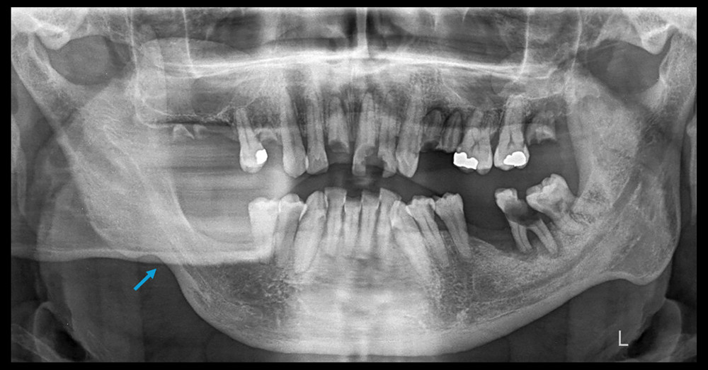 Twenty-five-month follow-up panoramic radiograph of case 6 showing complete healing of the lesion, with osseous regeneration and consolidation of the previous fracture site, resulting in restoration of mandibular continuity (blue arrow).