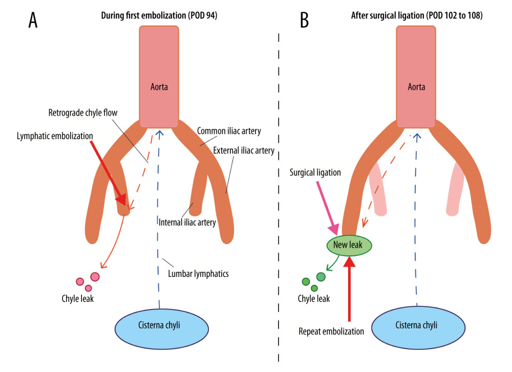 Schematic diagram of the hypothesized mechanism of dynamic redistribution of lymphatic leakage(A) During the first lymphatic embolization on postoperative day (POD) 94, retrograde chylous flow through the lumbar lymphatics may have contributed to persistent leakage from the internal iliac region (red droplets), despite ongoing embolization. (B) After surgical ligation of the internal iliac leak (POD 102), lymphatic flow may have been redirected through a collateral pathway (orange dashed arrow), resulting in a new leak in the external iliac region (green ellipse and droplets). Repeat embolization of this secondary leak site achieved definitive resolution. These schematics represent the authors’ proposed explanation for the observed sequential change in leak site and do not depict a definitively proven anatomical sequence.