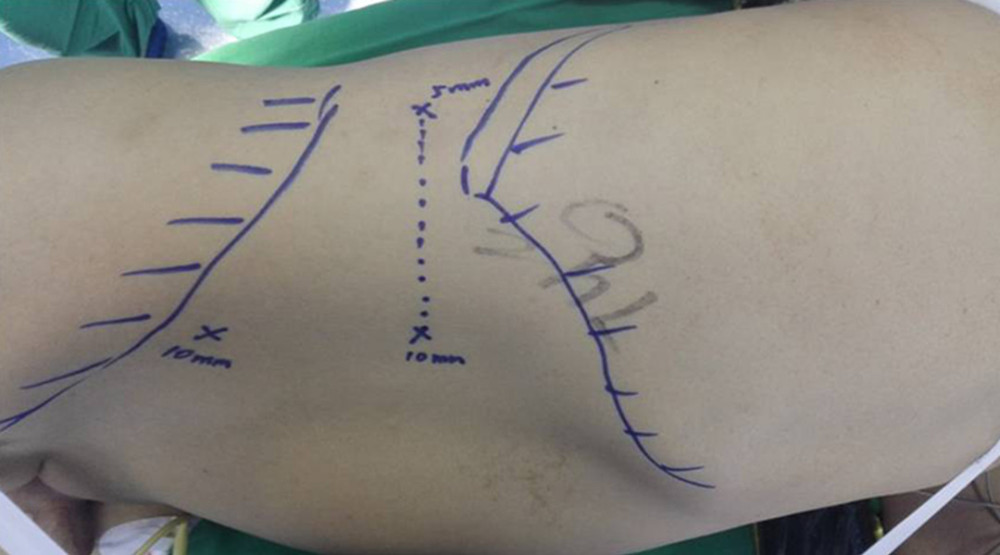 A 2-cm longitudinal incision is made 2 cm medial and superior to the right Anterior superior iliac spine. A 0.5-cm and 1.0-cm transverse incision are made in the posterior axillary line inferior to the 12th rib and in the anterior axillary line inferior to the 12th rib tip, respectively. Three ports are established. The distance is 6–8 cm between the 2 subcostal operating ports, facilitating the connection of the 2 ports during kidney extraction and controlling incision length.