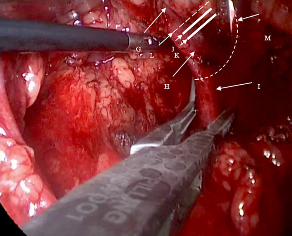 G: Right renal vein; H: the origin of the right renal vein; I: the inferior vena cava; J: the second Hem-o-lok; K: the first Hem-o-lok; L: the right renal vein is incised along the broken line for routine extraction of the right kidney. M: The renal vein is clamped at its origin in the direction of the inferior vena cava using vascular clamps or renal pedicle clamps and the renal vein is incised along the broken line. The origin of the right renal vein and partial inferior vena cava are preserved.