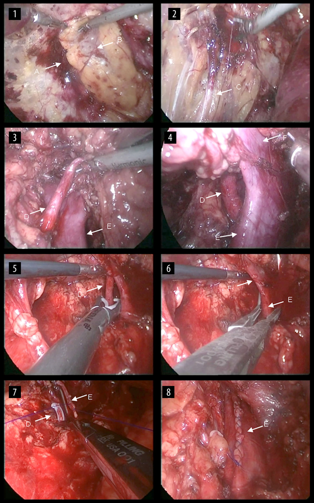 Surgical steps of right retroperitoneal laparoscopic live donor. nephrectomy. The renal fascia is opened (1), the ureter is fully dissociated (2), and then the right renal artery is dissected (3). The renal vein and the inferior vena cava are carefully dissected at their confluence (4). Then, the renal artery is clipped proximally (5), the renal vein is blocked at the confluence of the renal vein at the inferior vena cava and the renal vein is cut along with partial vena cava wall (6). The incision on the lateral wall of the inferior vena cava is then continuously sutured (7) and the vena cava after suturing is shown (8). A: the renal fascia; B: the right kidney; C: the ureter; D: the right renal artery; E: the inferior vena cava; F: the right renal vein.