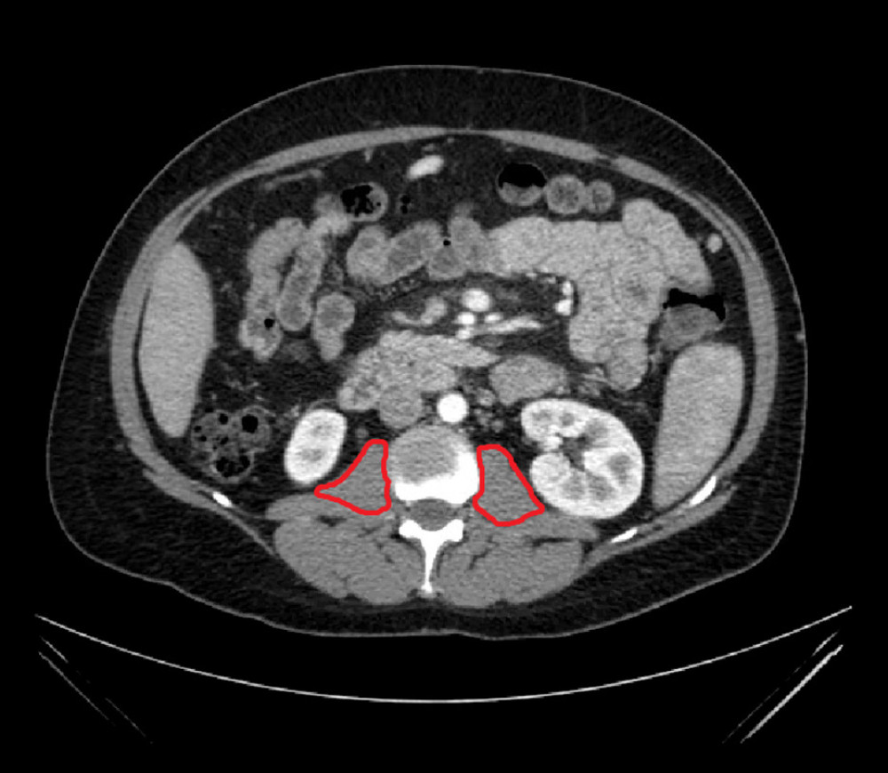 Cross section of patient CT scan at L2/L3 with bilateral psoas muscle areas highlighted.