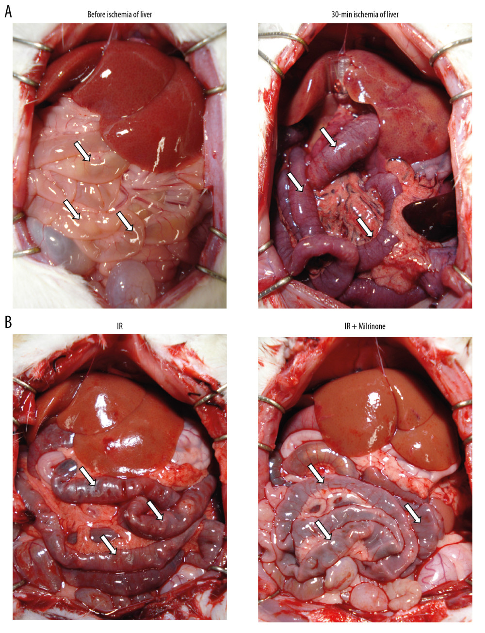 Macroscopic findings: Before ischemia of the liver, both the liver and small intestine showed no abnormalities. After 30 min of ischemia of the liver, the liver surfaces appeared ischemic and the small intestines became distended, congested, and dark red (A). Five hours after reperfusion, the liver surfaces of the ischemia–reperfusion (IR) and IR+milrinone groups appeared brown and slightly congested. The small intestines of the IR group remained congested and slightly distended. These findings in the small intestines were attenuated in the IR+milrinone group (B). White arrows, small intestine.