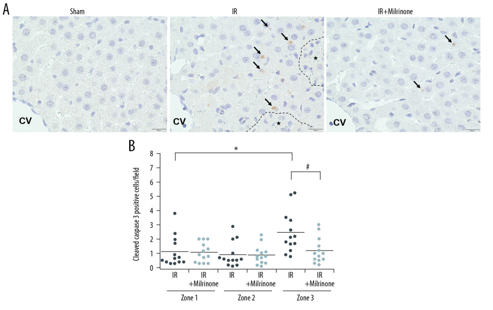 Assessment of cleaved caspase-3 expression in the liver parenchyma: The sham group had no cleaved caspase-3-positive cells in the hepatic parenchyma. In the ischemia-reperfusion (IR) group, cleaved caspase-3 was expressed in the cytoplasm of the hepatocytes (black arrows) around the necrotic area (*) in the pericentral zone (zone 3). The IR+milrinone group had fewer cleaved caspase 3-positive hepatocytes (A). The IR group had significantly more cleaved caspase-3-positive hepatocytes in zone 3 than in the periportal zone (zone 1). The IR+milrinone group had significantly fewer cleaved caspase-3-positive hepatocytes in zone 3 than did the IR group (B). * Significantly different (P<0.05) from zone 1 of the IR group. # Significantly different (P<0.05) from the IR group of the same zone. CV – central vein.