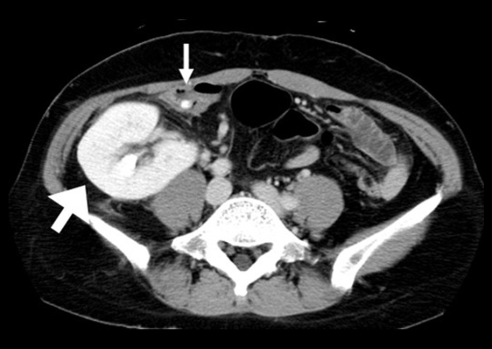The appendix with fecalith (small arrow) was pushed to medial aspect by the transplanted kidney (large arrow).