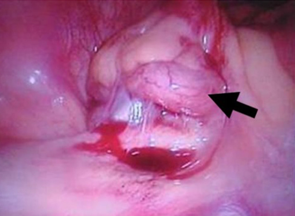 Tumor formation of appendicitis under laparoscopic view in a patient with kidney transplant.
