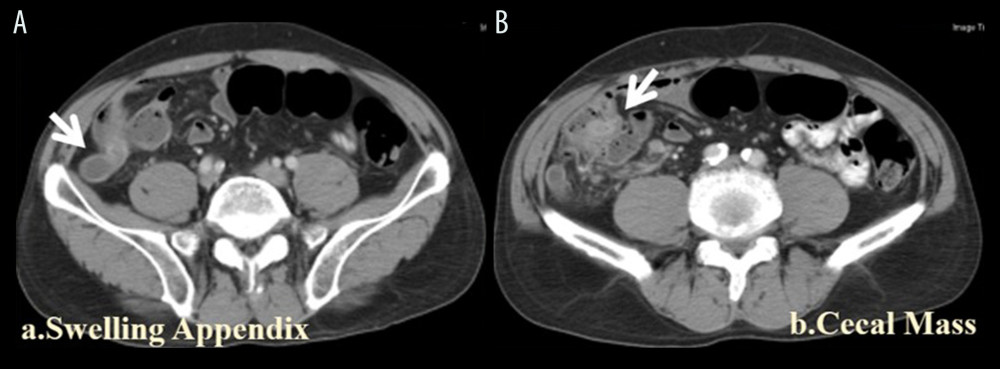 Cecal cancer. (A) Swollen and dilated appendix in a case with cecal tumor. (B) A polypoid tumor was noted in the cecum at the root of the appendix.