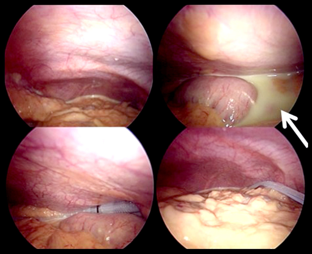 Yellowish turbid milky (chylous) ascites seen under laparoscopy.