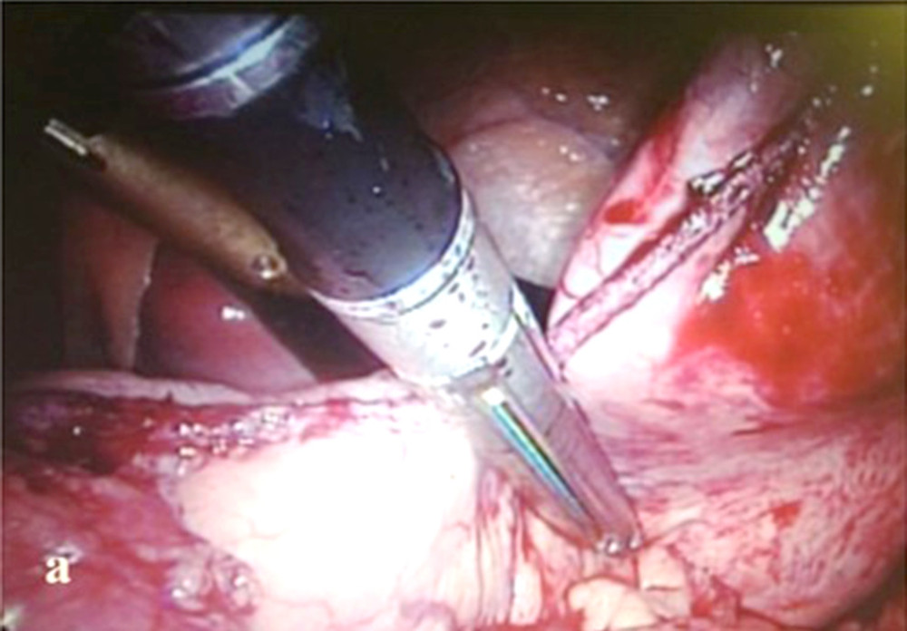 Laparoscopic sleeve gastrectomy in a patient with kidney transplant. Resection lateral to the oral gastric tube placed along the lesser curvature.