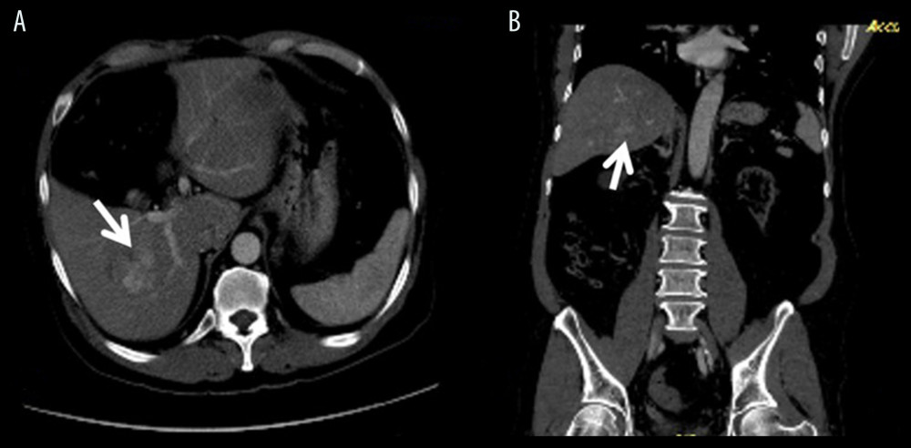 HCC. (A) A heterogenous early wash-out HCC in right lobe, segment 6, 7. (B) The same lesion on coronal section in CT abdomen.