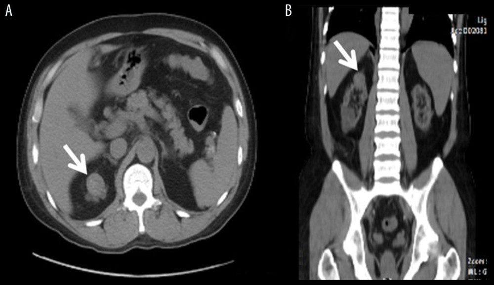 RCC. (A) A polypoid hyperdense tumor at the upper pole of right native kidney. (B) The same lesion seen in coronal section of CT abdomen.