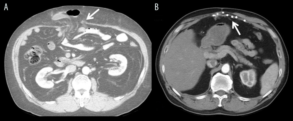 Incisional hernia. (A) Incisional hernia with evisceration. (B) Follow-up CT showed repair with mesh and no recurrence.