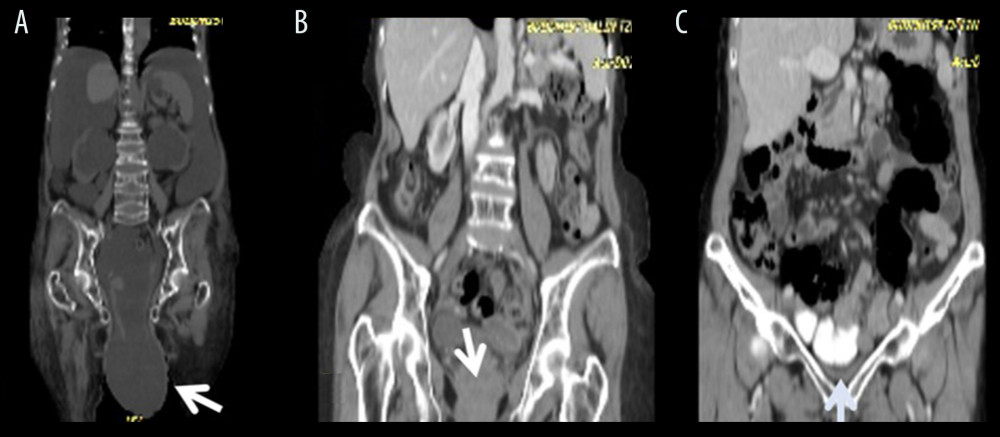 Prolapse uterus. (A) Severe uterine prolapse in liver cirrhosis due to massive ascites before liver transplant. (B) Persistent marked prolapse uterus after transplant. (C) No prolapse after reconstruction.