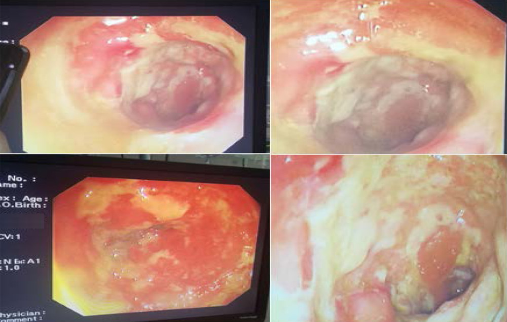 Bedside colonoscopy confirmed the diagnosis of pseudomembranous colitis in our patient.