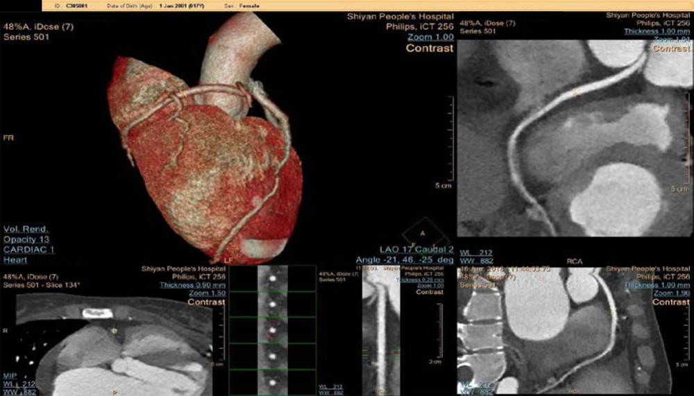 Coronary computed tomography angiography (CTA) was performed to delineate the underlying cause of cardiac arrest. The imaging finding suggests that the origin of the right coronary artery is at the top of the sinus. In the CTA, anomaly of origin of the right coronary artery was observed, in which the right coronary artery origin was above the intersinus ridge. The right coronary artery traveled between the aortic root and the right ventricular outflow tract. During strenuous exercise, the patient’s right ventricular outflow tract would thicken, compressing the right coronary artery origin, leading to myocardial ischemia and cardiac arrest.