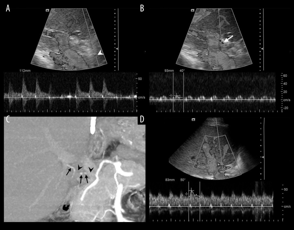 The 66-year-old male hepatocellular carcinoma patient received LDLT with right lobe graft. Right hepatic artery of the graft were anastomosed with the recipient’s right hepatic artery. An abnormal Doppler waveform was detected on post-LDLT day 12. (A) Doppler US demonstrated normal arterial curve at the pre-anastomotic artery (white arrowhead), and (B) tardus parvus waveform at post-anastomotic intrahepatic artery (RI=0.46, PSV=10.1 cm/s, white arrow). (C) Subsequent CTA on the same day demonstrated multifocal disruption of post-anastomotic artery (black arrowheads) and faint opacification of intrahepatic arterial filling (black arrows), suggesting partial occlusion. After IVT, (D) DUS on the next day demonstrated recovered arterial curve (RI=0.64, PSV=47 cm/s).
