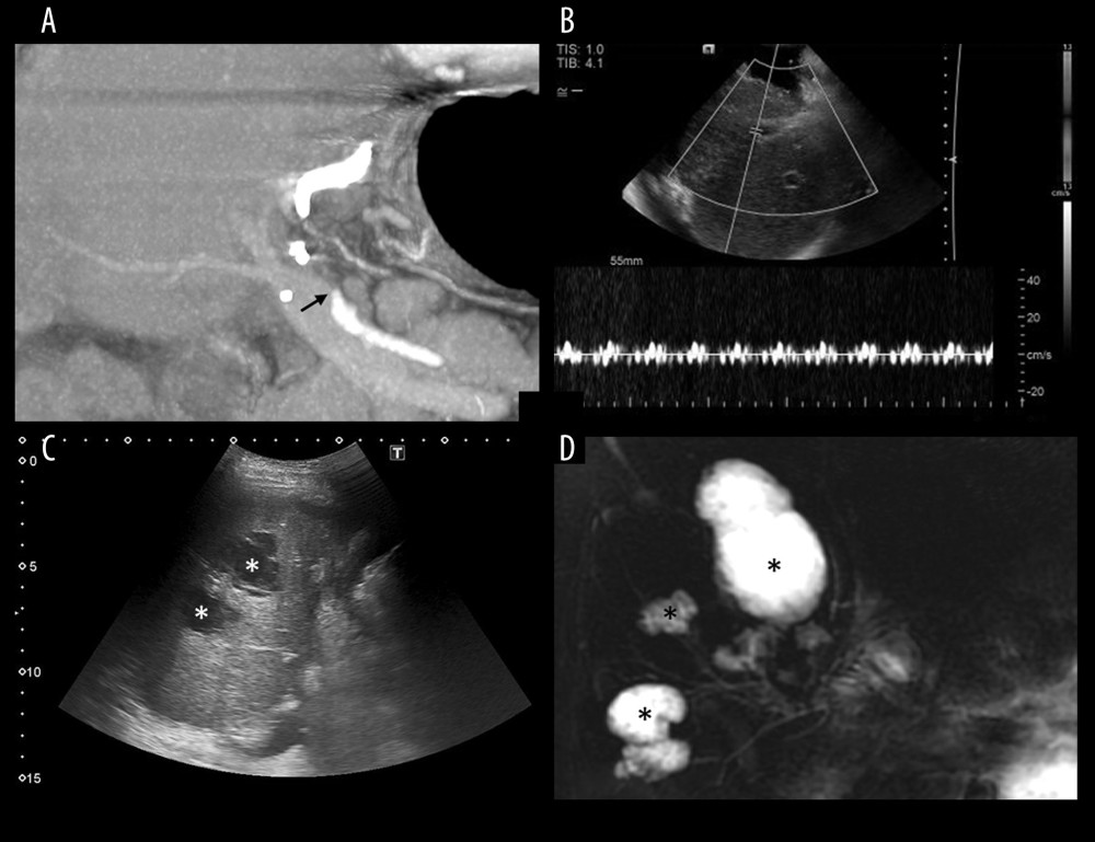 The 43-year-old male liver cirrhosis patient received LDLT with right lobe graft. Right anterior and right posterior hepatic arteries (RAHA and RPHA) of the graft were separately anastomosed with the recipient’s gastroepiploic artery and left hepatic artery. On post-LDLT day 1, DUS demonstrated complete absence of arterial wave of RAHA and RPHA (not shown). (A) CTA on the same day demonstrated disruption of periportal HA (black arrows) and non-opacification of intrahepatic arterial branches. (B) Intra-operation DUS on the same day demonstrated damped and irregular systolic upstroke and absent diastolic flow around the anastomotic site. Re-anastomosis of RAHA with gastroepiploic artery and IVT were done. Post re-anastomosis DUS showed recovered RAHA arterial blood flow (not shown in this picture). (C, D) Due to repeated arterial occlusion, multi-segmental non-anastomotic intrahepatic biliary strictures with bilomas (*) were noted 4 month later in US and MRCP. The patient received deceased donor liver transplantation 9 months later. The histologic findings of the LDLT allograft were ischemic necrosis, acute and chronic cholangitis, and multifocal abscess formation.