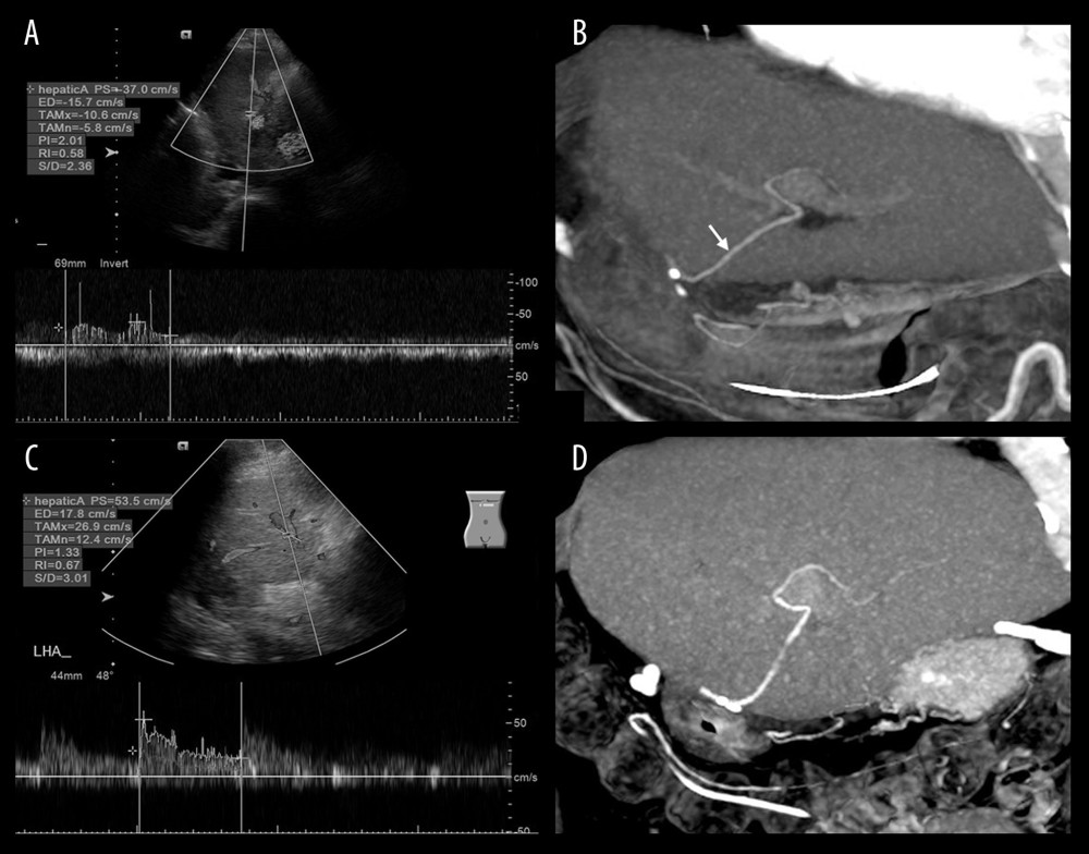 The 59-year-old male liver cirrhosis patient received LDLT with left lobe graft. Left hepatic artery of the graft was anastomosed with the recipient’s right hepatic artery. (A) Compared with the previous day, the Doppler US demonstrated declined arterial flow with prolonged systolic acceleration and small systolic amplitude on post-LDLT day 3. (B) Subsequent CTA on the same day demonstrated patency of LHA (white arrow) without any arterial filling defect or infarcted liver parenchyma. (C) Doppler US in following days demonstrated patency of LHA with relative normal arterial curve and resistance index=0.67. (D) Follow-up CTA 9 month later demonstrated regeneration of graft liver, patency of LHA, and no biliary dilatation.