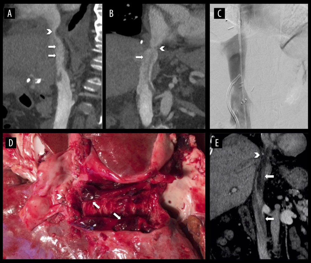 Radiologic and macroscopic finding of IVC thrombosis. (A–C): patient #1: CT scan (A, B) and cavography (C) of thrombus due to fibrotic stenosis (arrow heads) of suprahepatic IVC anastomosis; (D) patient #2 at autopsy with cranio-caudal opened IVC (from left to right); arrow head indicates suprahepatic IVC anastomosis; (E) CT scan showing a massive IVC thrombosis in patient #3 with arrowhead indicating stenotic suprahepatic IVC anastomosis. White arrows indicating thrombosis. Pictures A–C, and E are displayed in coronal view.