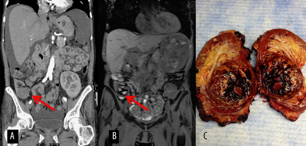Preoperative imaging of Case 2 with acquired cystic disease-associated RCC and gross specimen. (A) CT abdomen and pelvis from 3 years prior to transplant radical nephrectomy showing a cyst in the right transplant renal unit. (B) Preoperative MRI in 2013, renal mass in transplant unit marked by arrow. (C) Gross specimen from Case 2.