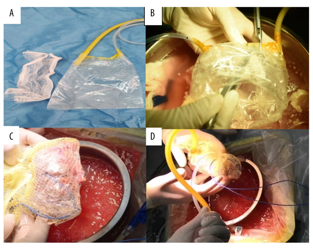 Components and assembly of net-restrictive plastic jacket. (A) Components: plastic bag and plastic net. (B) Denting the bottom of the sealed plastic bag to form a new cavity. (C) Placing the kidney into the cavity and closing the cavity from both sides of the bag with a titanium clip, leaving a gap in the middle for the vessels to be placed outside. Wrapping the plastic bag and kidney with the mesh bag, and opening a hole to place the renal blood vessels outside. (D) Assembly of the net-restrictive plastic jacket finished with tubes and probe.