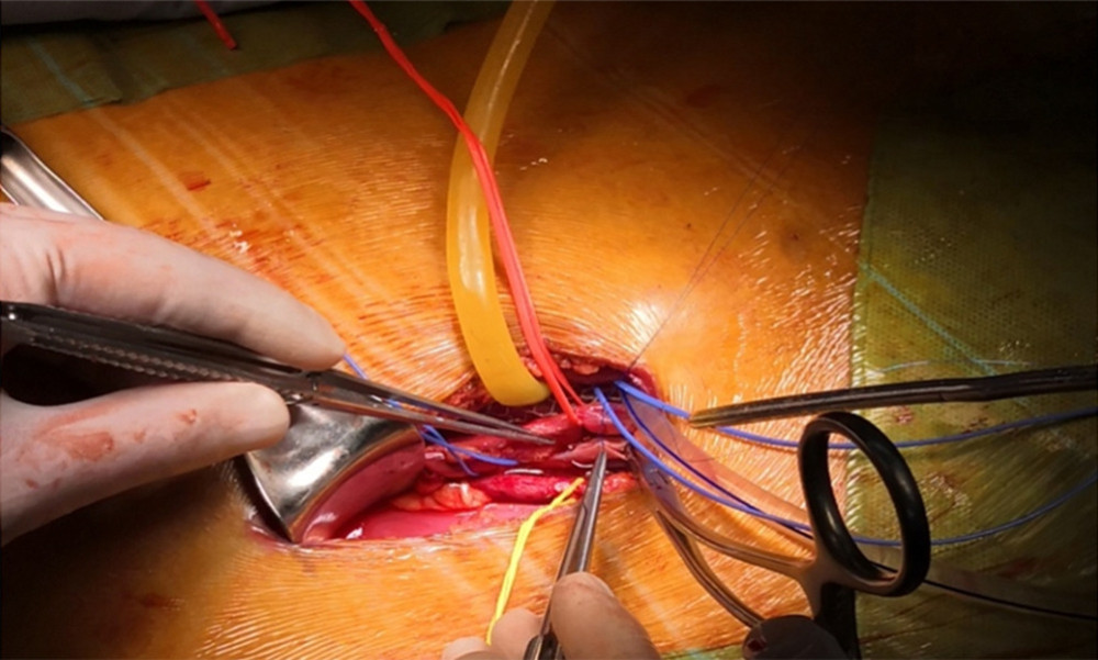Placement of the donor kidney and the cooling device into the extraperitoneal space for surgeons to complete the renal arteries and veins anastomosis. Only the inlet and outlet of the cooling device and the measuring electrode line crossed the incision.
