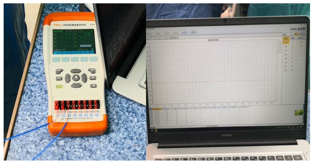 The real-time monitoring of graft kidney temperature during the renal artery and vein anastomosis.