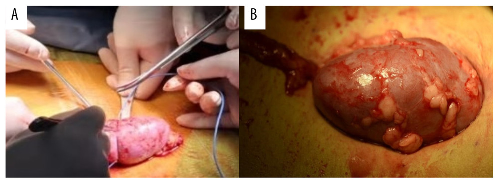 After the completion of revascularization, the transplanted kidney was bright red, with renal artery filling and good pulsation. The cooling jacket was cut to free the kidney, and the surgical team checked and verified that all components were completely removed, and the measuring electrode was removed (A). Minimal incisions can be smaller than the kidney (B).