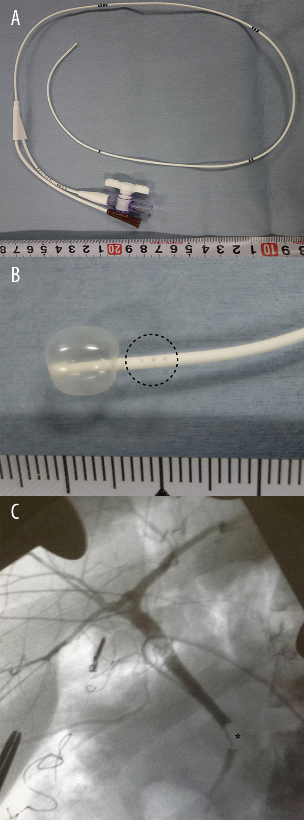 (A) Arrow Berman Angiographic Catheter, length 50 cm, external diameter 1.4 mm (4 Fr). The catheter is marked every 10 cm from the tip of the catheter. The air inlet to inflate the balloon has a stopcock. (B) Enlarged view of the tip of the catheter with the balloon inflated. The 3 side holes located at the proximal end of the balloon are circled with a dashed line. The balloon is inflated with 0.6 mL of air. (C) Intraoperative cholangiography of the living donor liver. The balloon is inflated in the distal bile duct (*). The biliary tree is peripherally enhanced.