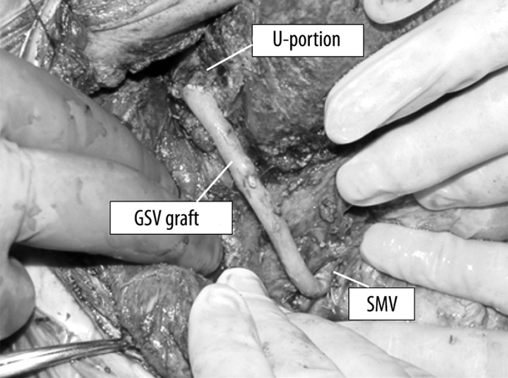 Intraoperative view of Case 1 after creation of the Rex shunt. GSV – greater saphenous vein; SMV – superior mesenteric vein.