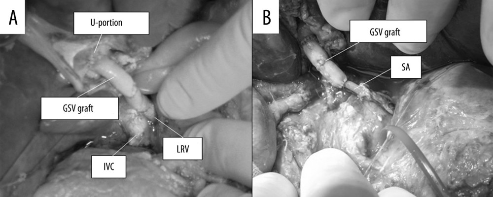 Intraoperative view of Case 2 after creation of the Rex shunt between the LRV and the U-portion of the graft using the donor’s GSV (A) and the SA (B). LRV – left renal vein; GSV – greater saphenous vein; SA – splenic artery; IVC – inferior vena cava.