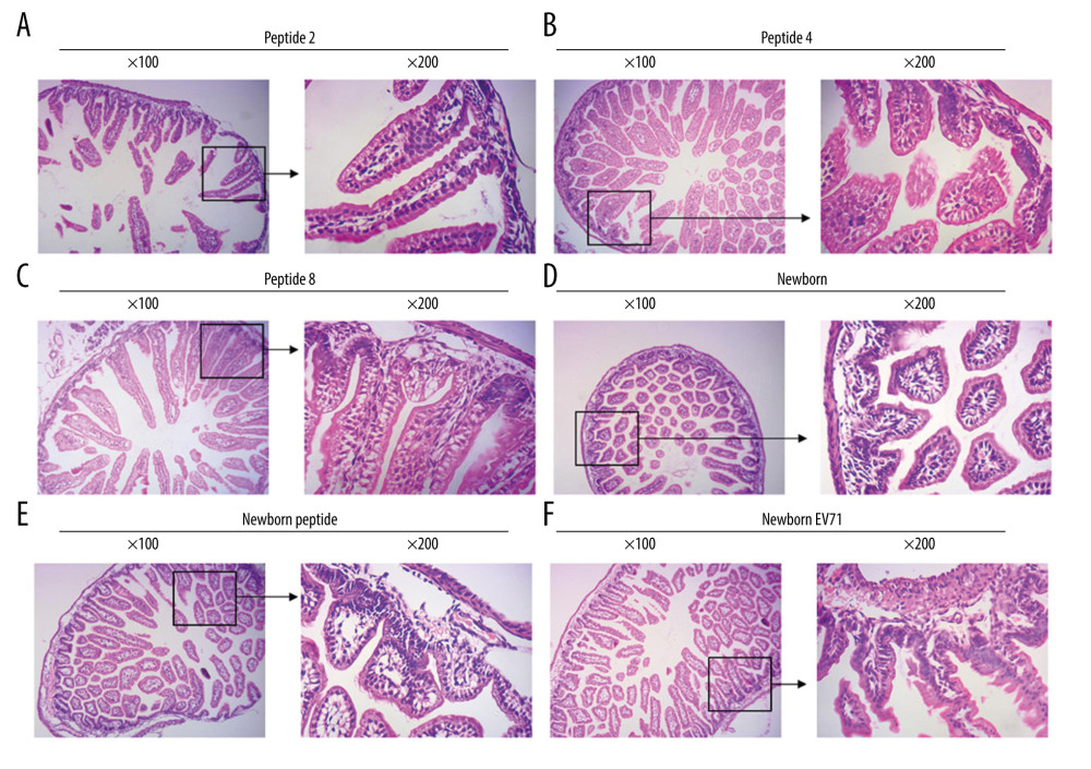 Peptide injections decrease the number of lesions in the small intestines of EV71-infected mice. Hematoxylin and eosin staining of small intestines tissues in the (A) Peptide 2, (B) Peptide 4, (C) Peptide 8, (D) Newborn, (E) Newborn peptide, and (F) Newborn EV71 groups. EV71 – enterovirus 71.