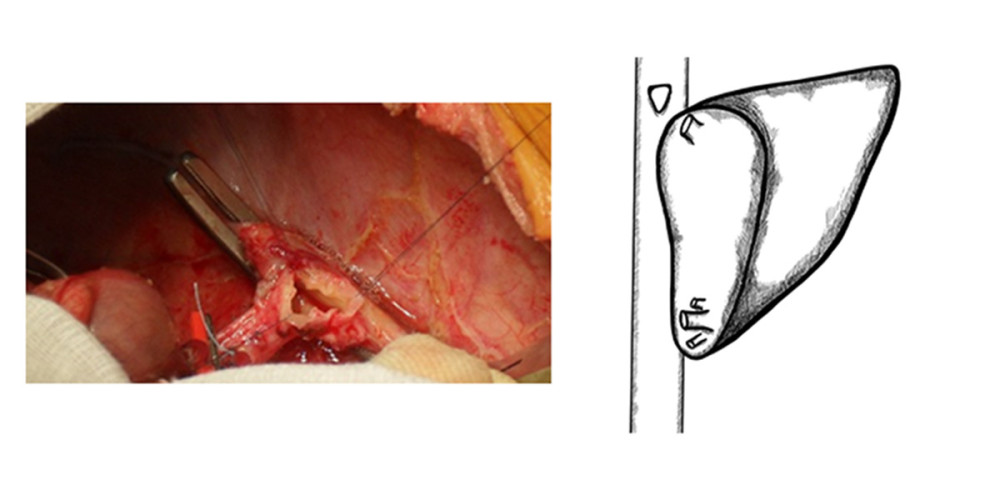 Typical anastomosis of graft HV to the recipient’s IVC – triangle-shaped anastomosis.