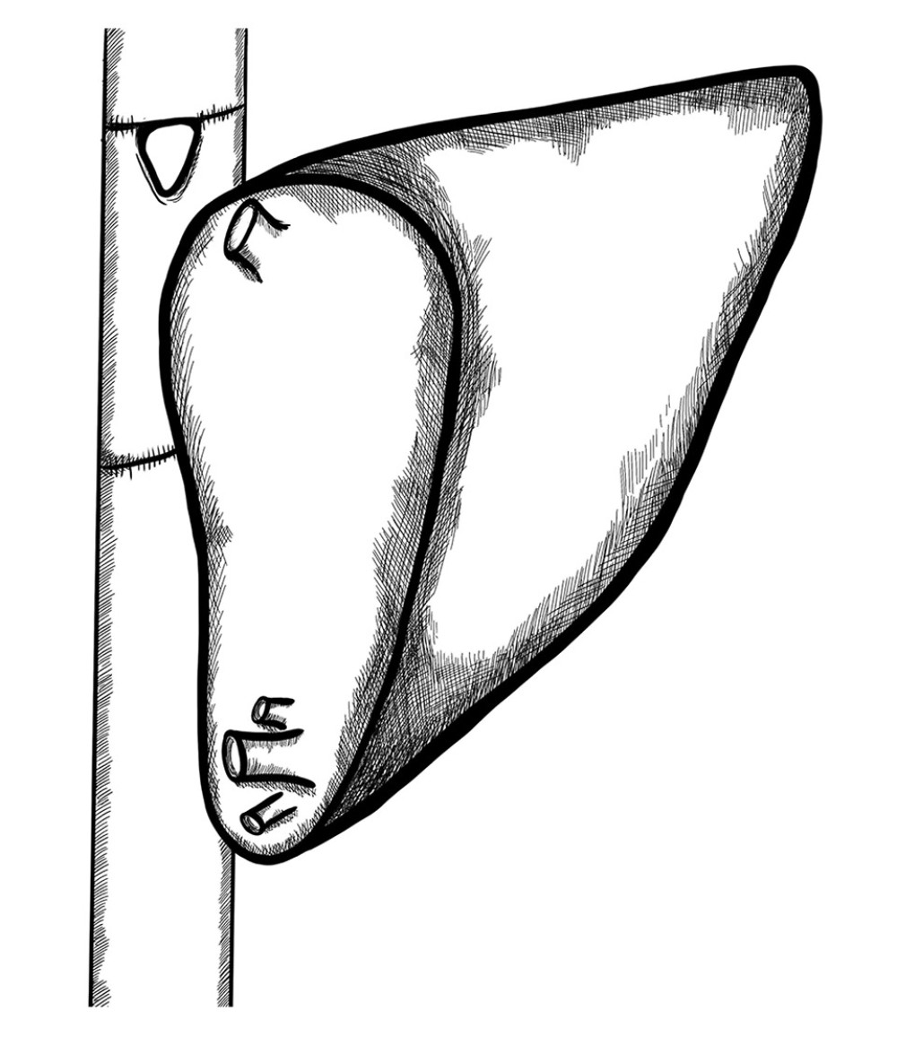 Retrohepatic vena cava reconstruction using a deceased donor venous graft.