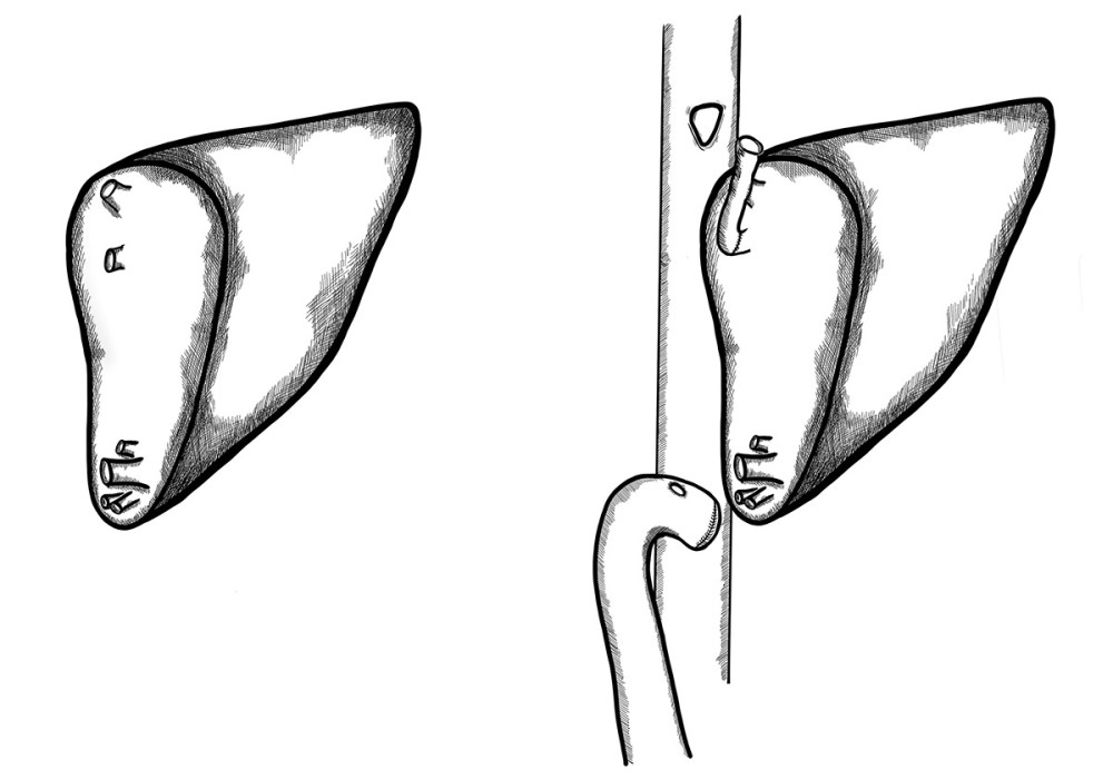 Long distance between 2 hepatic venous branches of the graft (segment II, III), reconstruction using a deceased donor venous graft.