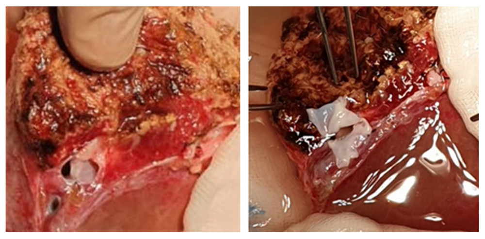 A very deep confluence of the 2 hepatic veins with an extremely short cuff. Reconstruction of the cuff of hepatic veins – back table.