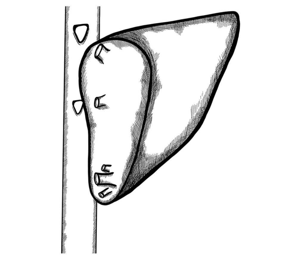 Two separate triangle-shaped end-to-side anastomoses to the recipient’s IVC.