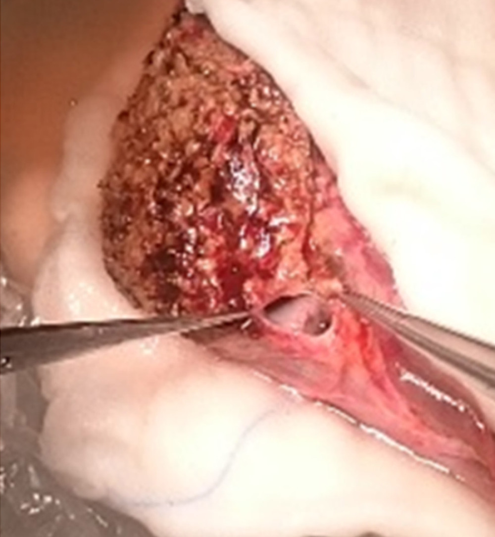 Back-table reconstruction of venous outflow in the case of multiple hepatic veins – triangle-shaped anastomosis.