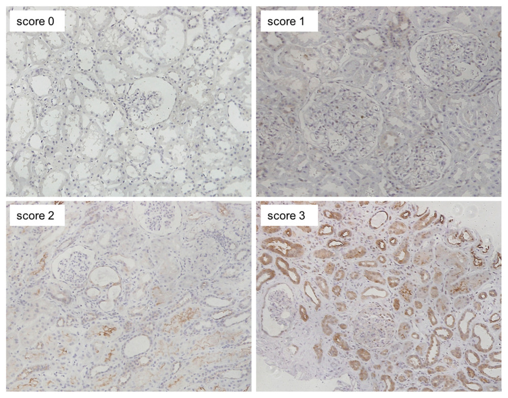 Representative images of immunohistochemical staining (scores 0–3 of p-mTOR staining). Positive staining was mainly observed in the cytoplasm of renal proximal and distal tubules, and slightly in glomeruli (magnification: ×200). p-mTOR – phosphorylated mammalian target of rapamycin.