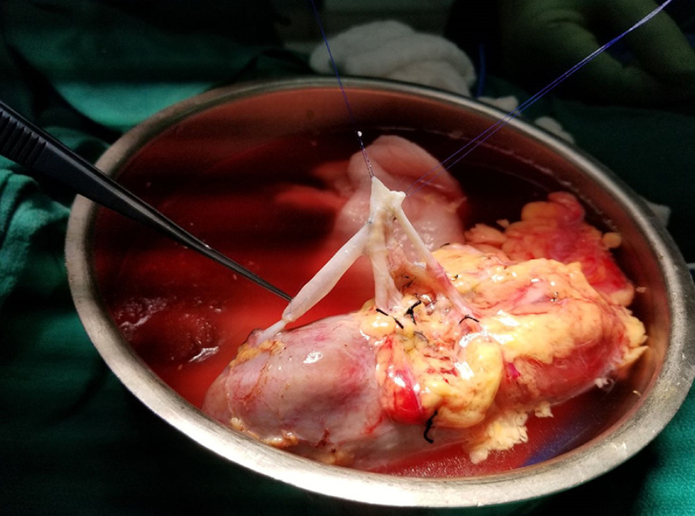 Reconstruction of upper pole artery using donor ovarian vein as extension graft and reconstruction of lower pole artery through side-to-side anastomosis with the main renal artery